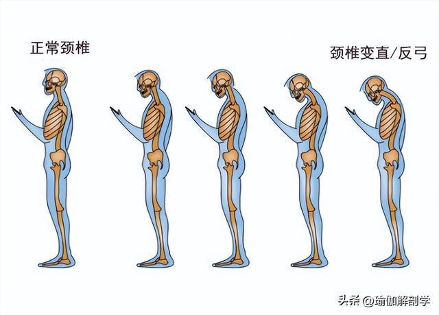 每天这样瑜伽开肩颈椎自然就不痛了！(图1)