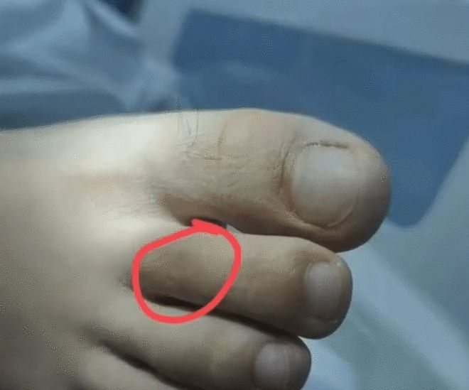 三亚被蛇咬伤致死女子伤口画面曝光：脚趾上的小伤口不细看难发现(图1)