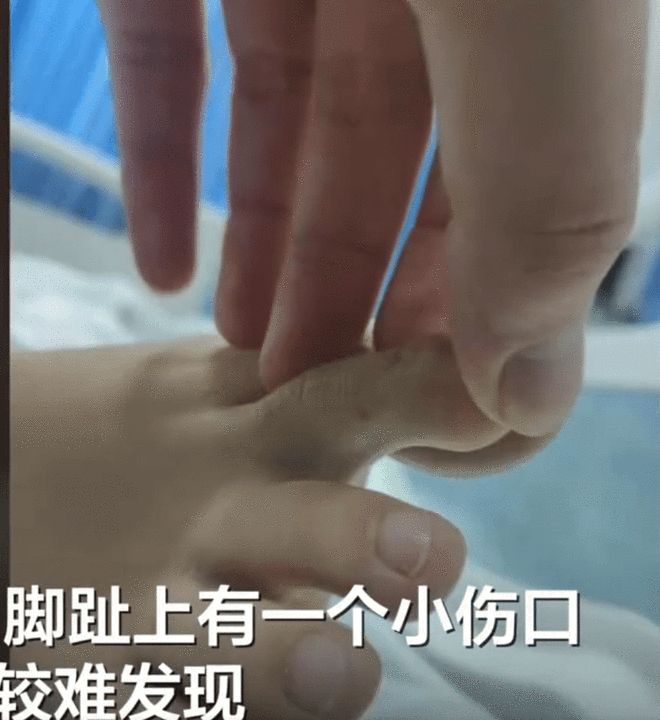 三亚被蛇咬伤致死女子伤口画面曝光：脚趾上的小伤口不细看难发现(图2)
